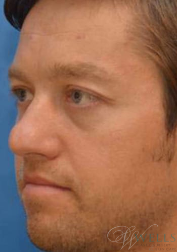 Before Image: Botox - left-front-oblique