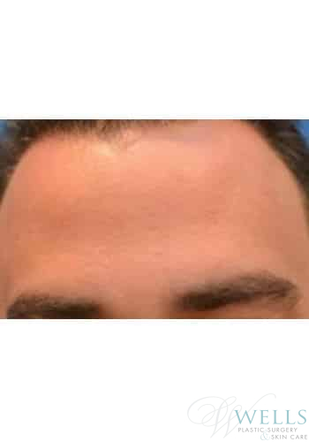 After Image: Botox - other