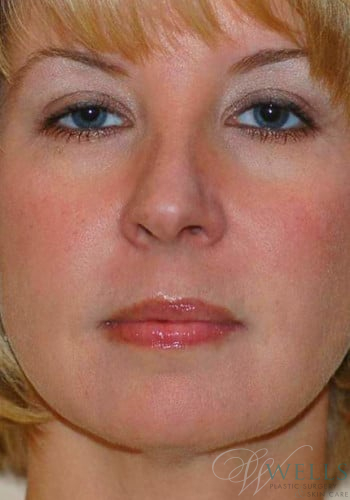After Image: Botox - front