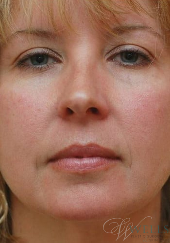 Before Image: Botox - front