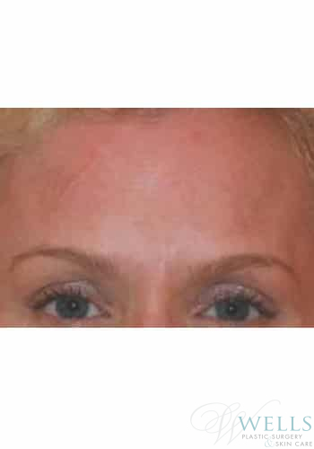 After Image: Botox - front