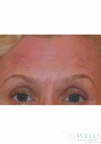 Before Image: Botox - front