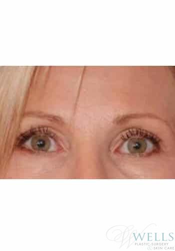 After Image: Botox - front