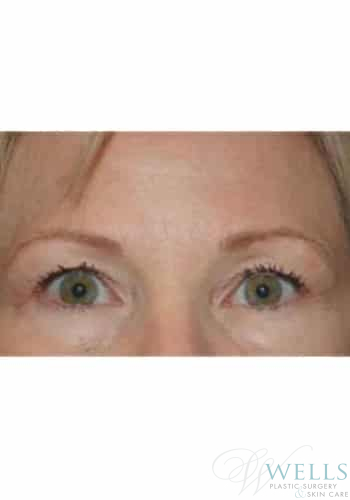 Before Image: Botox - front
