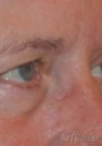 After Image: Botox - right-front-oblique