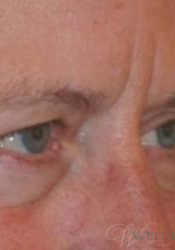 Before Image: Botox - right-front-oblique