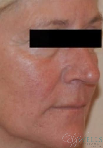 After Image: Botox - right-front-oblique