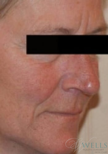 Before Image: Botox - right-front-oblique