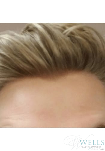 After Image: Botox - front