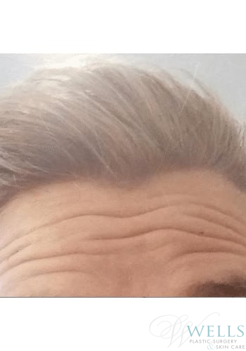 Before Image: Botox - front