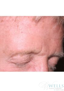 After Image: Botox