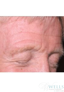 Before Image: Botox