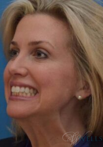 Before Image: Botox