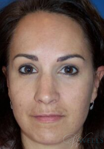 After Image: Brow Lift