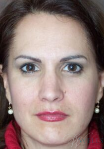 Before Image: Brow Lift