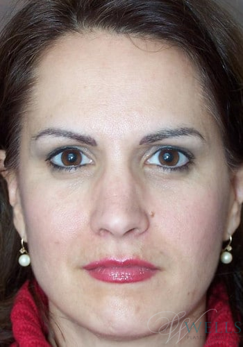Before Image: Brow Lift - front