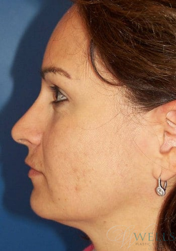 After Image: Brow Lift - left-side
