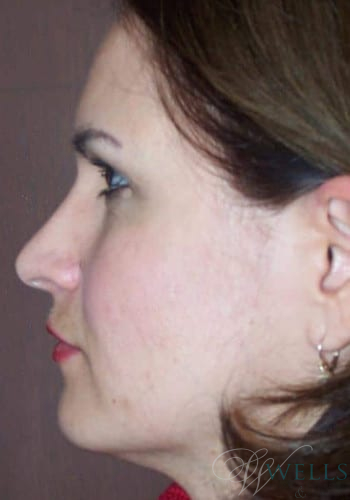 Before Image: Brow Lift - left-side