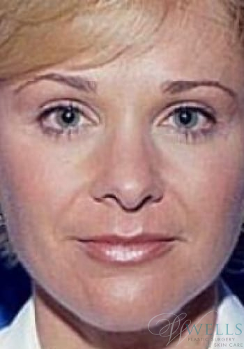 After Image: Brow Lift - front
