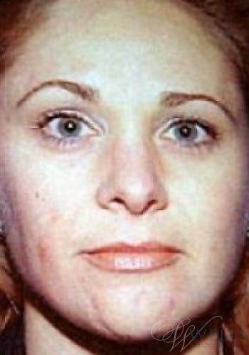 Before Image: Brow Lift - front