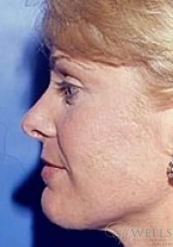 After Image: Brow Lift - left-side