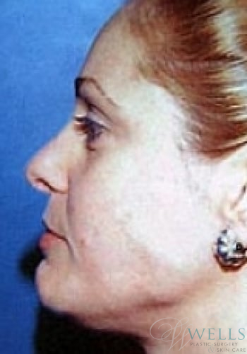 Before Image: Brow Lift - left-side