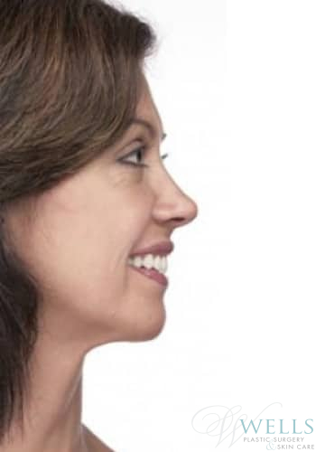 After Image: Chin Liposuction - right-side