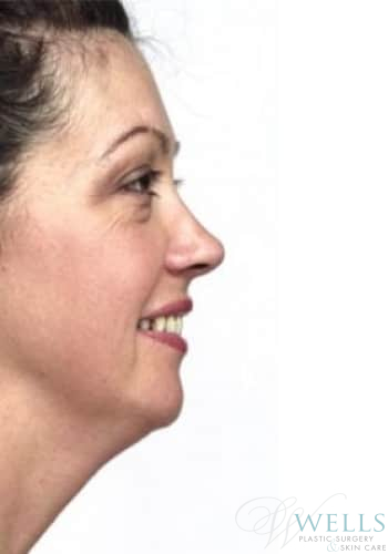 Before Image: Chin Liposuction - right-side