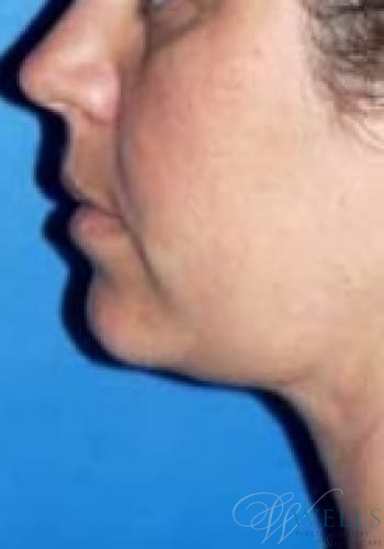 After Image: Chin Liposuction - left-side