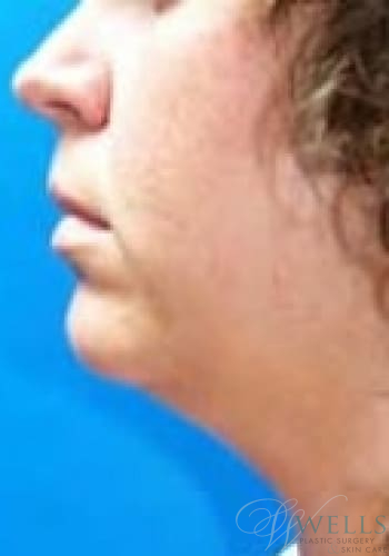 Before Image: Chin Liposuction - left-side