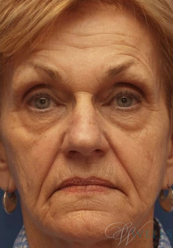 Before Image: Combination Skin Care - front