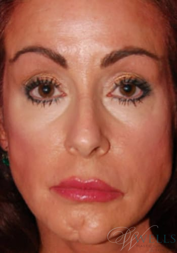 Before Image: Combination Skin Care - front