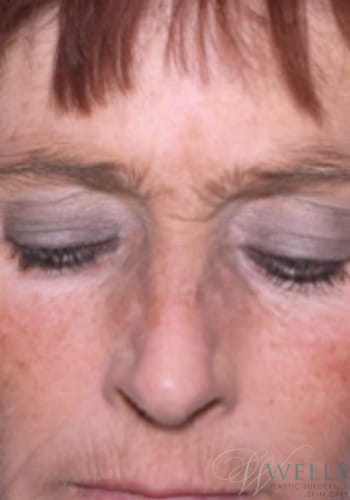 Before Image: Combination Skin Care - front