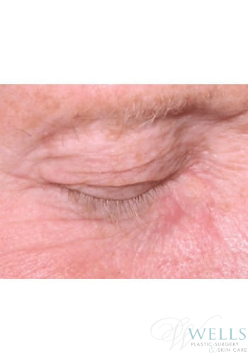 After Image: Cryotherapy - right-front-oblique