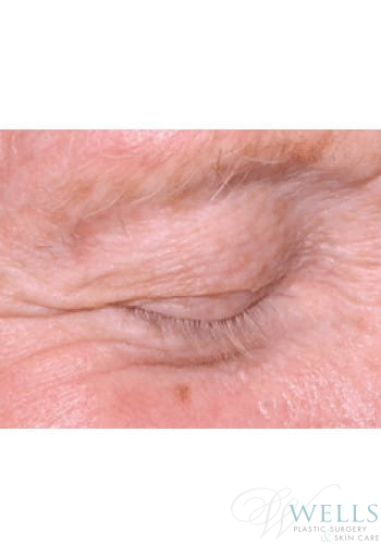 Before Image: Cryotherapy - right-front-oblique