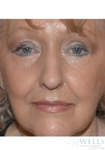 After Image: Facelift - front