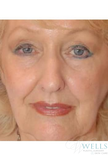 Before Image: Facelift - front