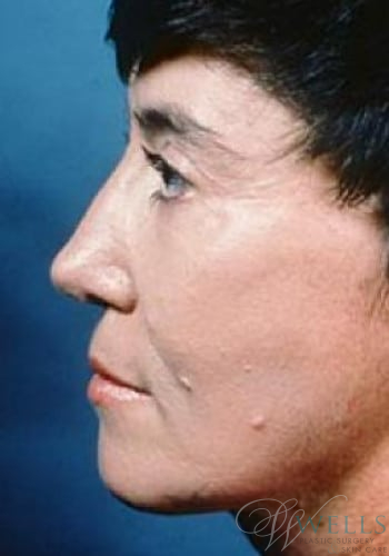After Image: Facelift - left-side