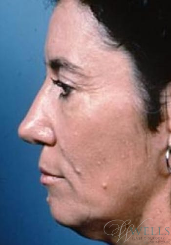 Before Image: Facelift - left-side