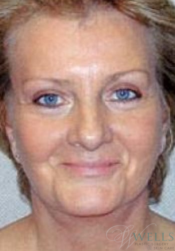 After Image: Facelift - front