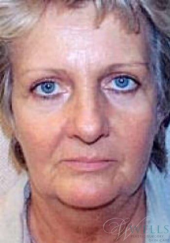 Before Image: Facelift - front