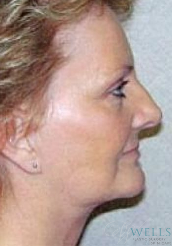 After Image: Facelift - right-side
