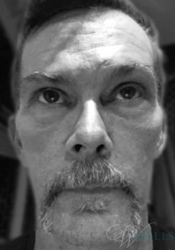 Before Image: Facelift - front