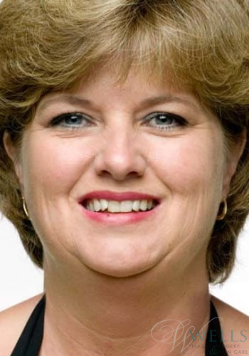 Before Image: Facelift - front
