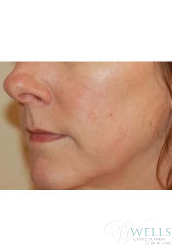 After Image: IPL - left-front-oblique