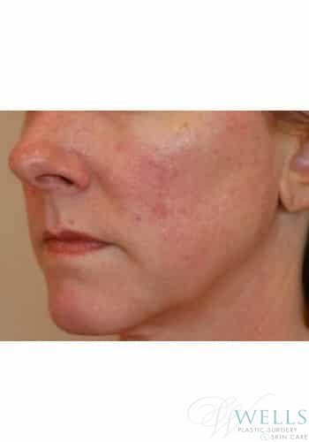 Before Image: IPL - left-front-oblique
