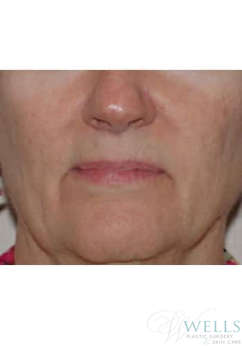 After Image: IPL - front