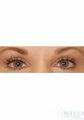 After Image: Latisse - front