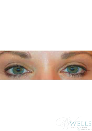 Before Image: Latisse - front