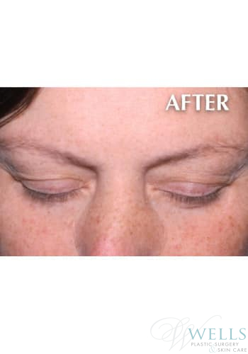 After Image: Latisse - front